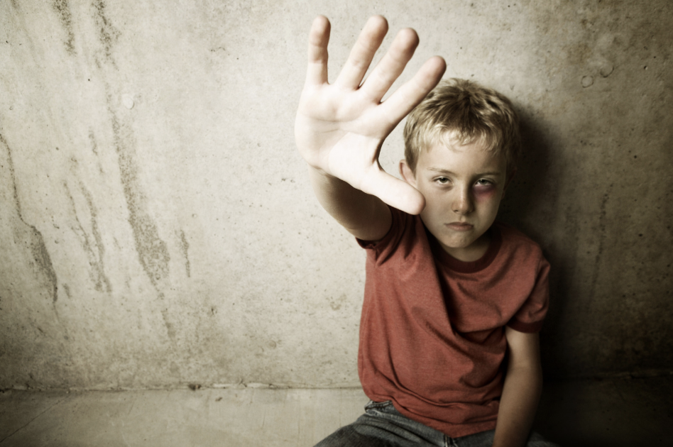 a young boy with a black eye holding his hand up to the viewer 